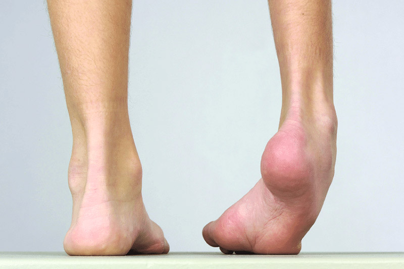 DEFICIT DES MUSCLES RELEVEURS DU PIED - Chaussures et semelles