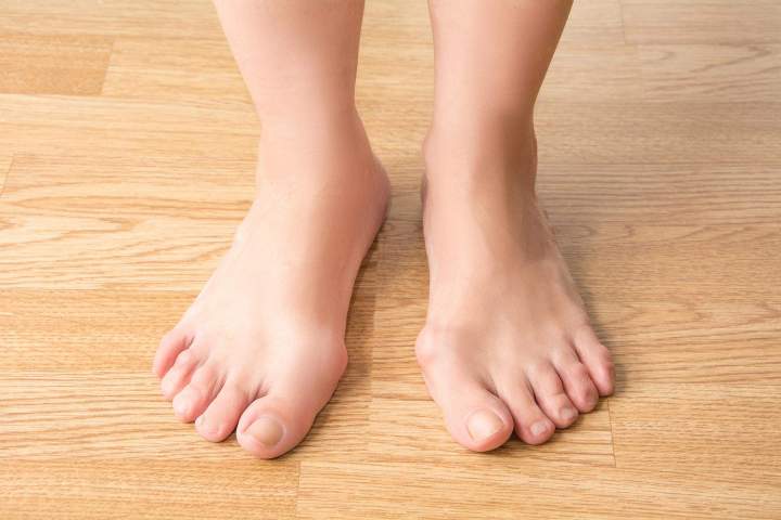 Hallux valgus Paris